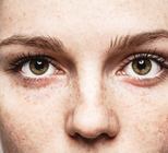 תיקון פזילה במבוגרים: משקפיים או ניתוח?-תמונה